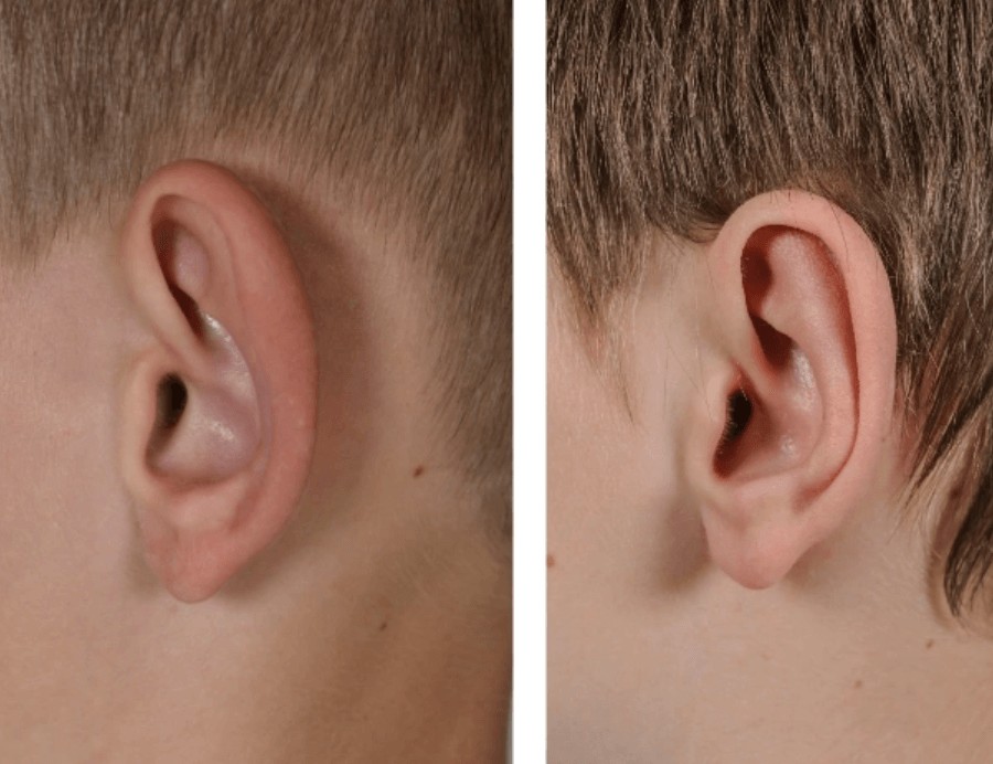 Oorcorrectie (Otoplastiek)